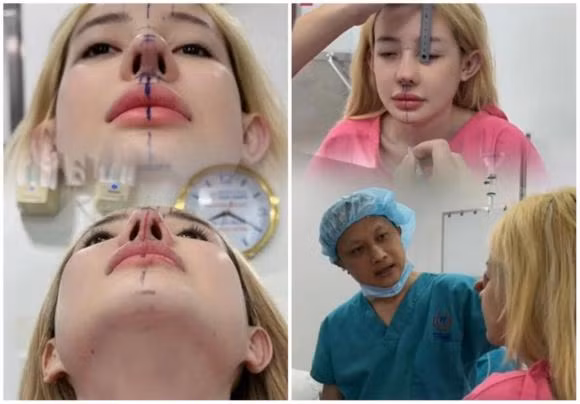 Mới đây, hình ảnh Ngân 98 đến gặp bác sĩ phẫu thuật thẩm mỹ để tháo sụn và chỉnh sửa mũi lần thứ 12 làm xôn xao cõi mạng. Được biết, sau khi sửa mũi ở Hàn Quốc về, Ngân 98 gặp phải tình trạng khó thở. Đến thời điểm hiện tại, cô đã có thể thở bình thường. Tuy vậy, sau khi "sửa sang" lần thứ 11, mũi của Ngân 98 có dịch viêm. Ảnh: Thương Hiệu và Pháp Luật