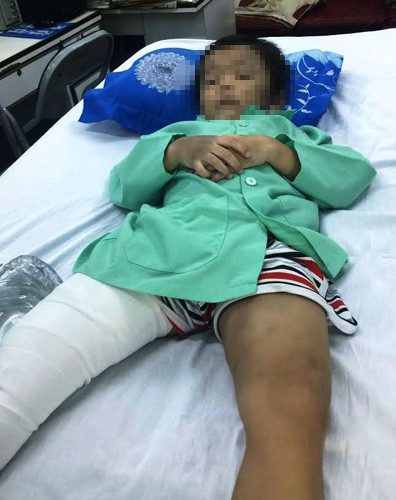 Bé Thiện đang điều trị tại BV trong tình trạng gãy xương đùi và bầm từ đầu, mặt, thân mình và tứ chi