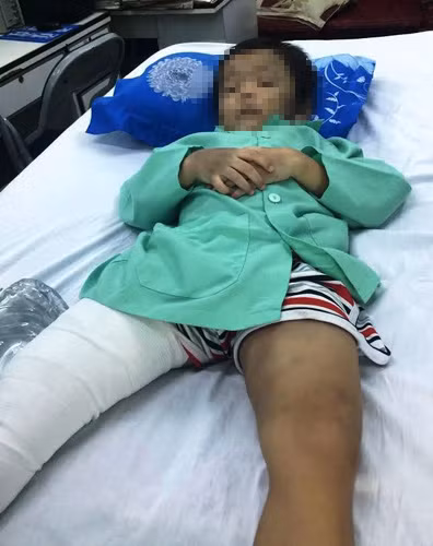 Bé Thiện đang điều trị tại BV trong tình trạng gãy xương đùi và bầm từ đầu, mặt, thân mình và tứ chi