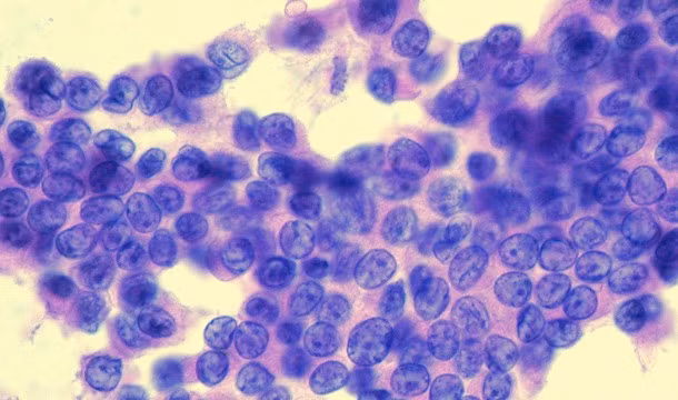 Tổ chức Greenpeace ước tính có tới 60.000 ca mắc bệnh ung thư tuyến giáp do thảm họa hạt nhân Chernobyl. Ảnh: List25.