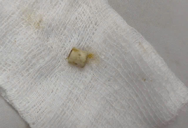 Dak Lak: Be trai 6 tuoi mac mot luc nhieu di vat duong tho-Hinh-2