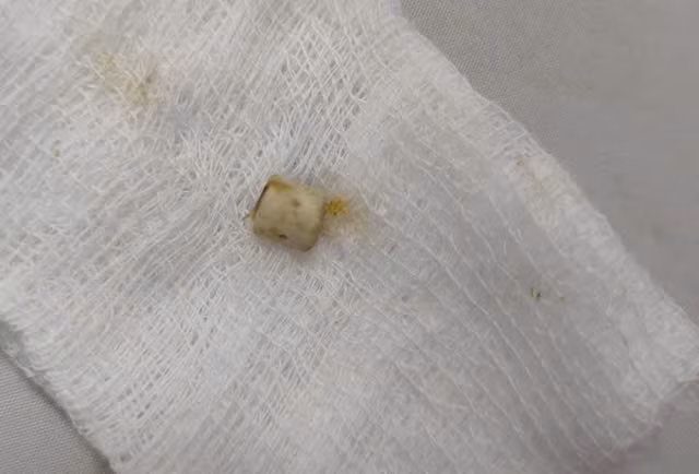 Dak Lak: Be trai 6 tuoi mac mot luc nhieu di vat duong tho-Hinh-2