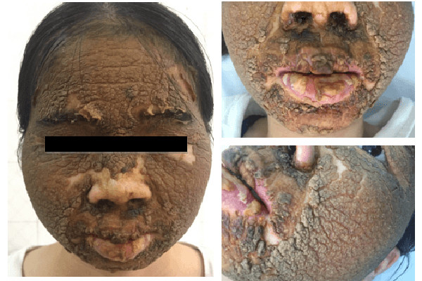 Da mặt cô gái trẻ tróc vảy từng lớp dày