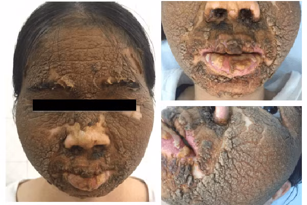 Da mặt cô gái trẻ tróc vảy từng lớp dày