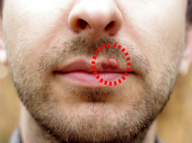 8 nguyên nhân gây nứt nẻ môi và cách phòng tránh - Hình 7 8 nguyen nhan gay nut ne moi va cach phong tranh-Hinh-7