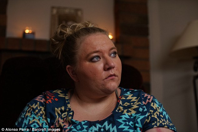 Trong khi hầu hết những người mắc phải hội chứng này có cảm giác đau mạn tính, đổ mồ hôi và sưng tại các khu vực bị ảnh hưởng, thậm chí có người còn có cảm giác đau đến mức như bị đốt cháy, bị đâm vào da thịt thì cô Kayla thực sự bị tổn thương bởi làn da có thể tự bốc cháy hoặc bỏng từ bên trong.