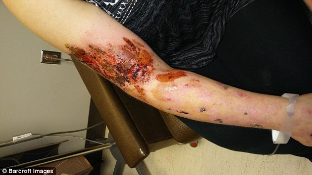 CRPS được đánh giá là căn bệnh có mức độ đau đớn cao nhất trên thế giới. CRPS khiến bệnh nhân cảm thấy họ đau đớn hơn bất kỳ phẫu thuật cắt cụt nào. Nó thậm chí còn đau vượt mức độ đau của sinh đẻ tự nhiên, gãy xương và ung thư. CRPS cũng được gọi là "căn bệnh tự tử" vì rất nhiều người đã lựa chọn tự tử khi bị chẩn đoán mắc phải căn bệnh kinh khủng này".