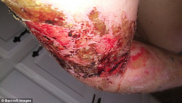 Cô Kayla cũng nói thêm rằng, cô cảm thấy từ đầu đến chân bị ai đó đổ xăng sau đó châm lửa đốt và nhét vào thùng rác. Trên thang điểm từ 1 đến 10, các cơn đau do hội chứng CRPS của cô Kayla luôn ở mức 10.