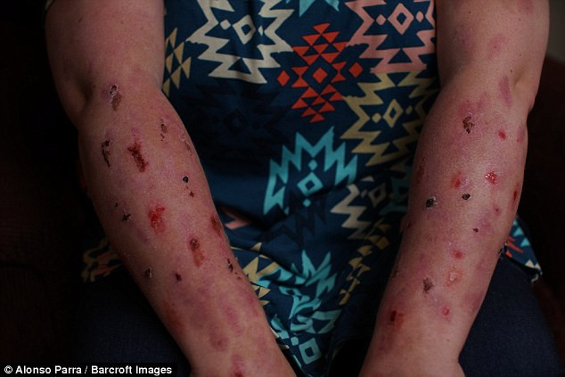 Hiện tại, cô Kayla không thể lái xe hay làm các việc bình thường như rửa tay, bởi làn da của cô bị phồng rộp như bỏng, rất đau đớn vì hội chứng CRPS.