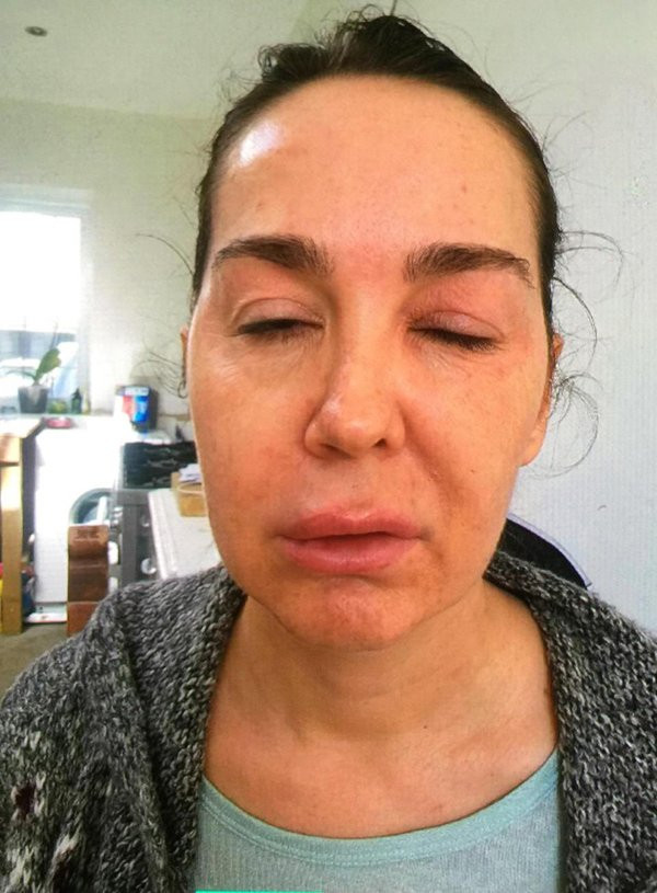 Belinda bị bại liệt do độc tố thần kinh được sử dụng khi tiêm botox.