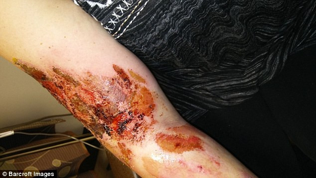 Chia sẻ về căn bệnh của mình, cô Kayla nói: "CRPS là tình trạng hệ thần kinh của bạn tấn công toàn bộ cơ thể của bạn. Ở một số người, nó sẽ xuất hiện ở cánh tay hoặc chân. Trong trường hợp của tôi, khu vực bị ảnh hưởng là toàn cơ thể.