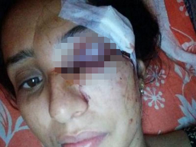 Nạn nhân với cơ thể đầy thương tích sau khi bị chồng bạo hành.