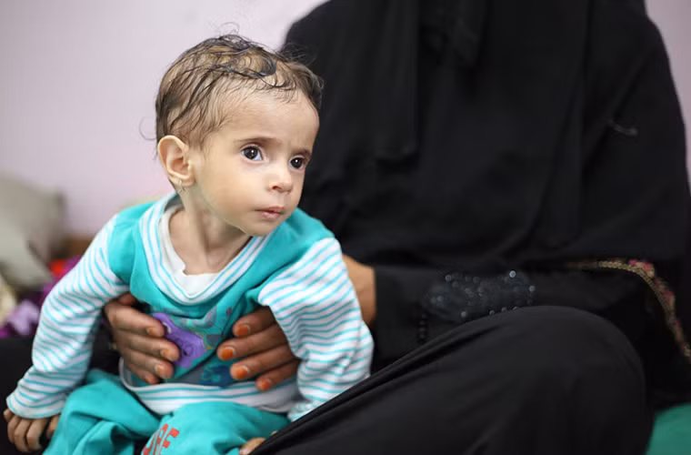 Nhiều trẻ em Yemen bị suy dinh dưỡng trầm trọng. Ảnh: Bé Fatima 1 tuổi nhưng chỉ nặng 4,2 kg. Ảnh: AJ.