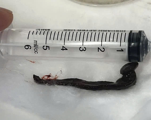 Phat hien con vat dai hon 6 cm song trong mui benh nhan