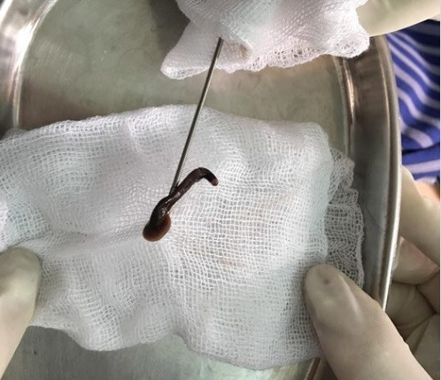 Hoang hon nhung truong hop dia chui vao nguoi kinh di