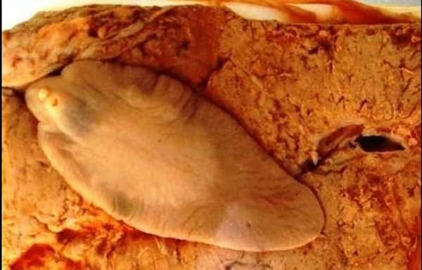 Chị H. nhập viện với triệu chứng sốt, tổn thương phần mềm vùng ngực phải. Sau khi làm các xét nghiệm, bác sĩ xác định bệnh phẩm là sán lá gan lớn (Fasciola) ở ngực. Chị H. chia sẻ, ngoài việc thỉnh thoảng thấy nhói nhẹ ở ngực, chị không có triệu chứng gì đặc biệt. Ảnh: VTC. 