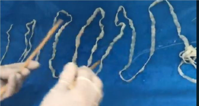 Trước đây, Viện Sốt rét Ký sinh trùng Côn trùng TPHCM từng xổ được một con sán có chiều dài khoảng 6m trong cơ thể bệnh nhân nam. Đây là con sán dây có chiều dài “khủng” đứng thứ hai được xổ ra ngoài thành công. Một trường hợp khác sau khi xổ bắt được 2 con, mỗi con có chiều dài hơn 2m. Ảnh: Tiền Phong.