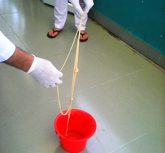 Cũng trong tháng 11/2018, bệnh viện Đa khoa Vĩnh Đức, thị xã Điện Bàn, tỉnh Quảng Nam cho biết, đơn vị đã tiến hành biện pháp can thiệp y tế lấy ra từ bụng bệnh nhân một con sán xơ mít dài 8m. Ảnh minh họa: Internet. 