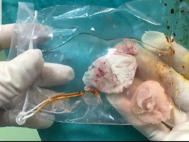 Ngày 21/3, thông tin từ BV Đa khoa tỉnh Phú Thọ cho biết, Khoa Ngoại thần kinh của BV vừa tiếp nhận trường hợp nam bệnh nhân có ổ sán não khổng lồ ở bán cầu trái và vùng thái dương đỉnh phải. Ảnh: Pháp luật TPHCM.