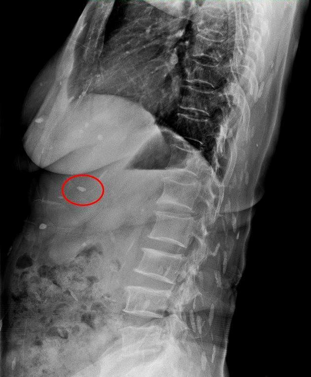Với những dấu hiệu lâm sàng, Bác sĩ đã khám và chỉ định làm những chỉ định sâu hơn để chẩn đoán: Xét nghiệm phân, chụp X – Quang tim phổi, chụp X – Quang ổ bụng không chuẩn bị, siêu âm ổ bụng…Các kết quả cho thấy người bệnh mắc bệnh sán lá gan sinh sống trong cơ thể nhiều năm. Ảnh: GĐVN.