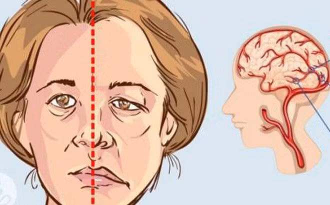 Dấu hiệu sớm của tai biến mạch máu não ai cũng cần biết - Hình 2 Dau hieu som cua tai bien mach mau nao ai cung can biet-Hinh-2