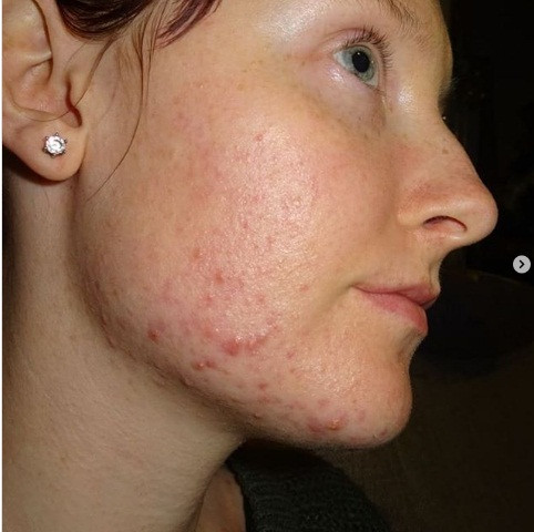 Có mụn trên cằm: Khoảng 2 tuần trước khi có kinh nguyệt, cơ thể bạn tăng estrogen và progesterone. Do sự thay đổi nồng độ hormone này, bạn có thể gặp phải tình trạng mụn trứng cá ở cằm sẽ biến mất sau một thời gian. Tuy nhiên, nếu bạn thường xuyên nổi mụn ở hàm hoặc cằm, điều đó có thể có nghĩa là nội tiết tố bị cạn kiệt và bạn cần gặp bác sĩ trước khi nó quá muộn.