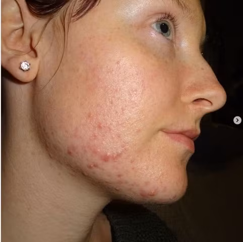 Có mụn trên cằm: Khoảng 2 tuần trước khi có kinh nguyệt, cơ thể bạn tăng estrogen và progesterone. Do sự thay đổi nồng độ hormone này, bạn có thể gặp phải tình trạng mụn trứng cá ở cằm sẽ biến mất sau một thời gian. Tuy nhiên, nếu bạn thường xuyên nổi mụn ở hàm hoặc cằm, điều đó có thể có nghĩa là nội tiết tố bị cạn kiệt và bạn cần gặp bác sĩ trước khi nó quá muộn.