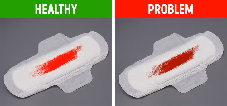 Có cục máu đông trong kỳ kinh nguyệt: Kỳ “đèn đỏ” của mọi người là khác nhau, cục máu đông xuất hiện 1-2 lần là bình thường. Tuy nhiên, nếu máu kinh của bạn chuyển sang màu tối và các cục máu đông đều và to thì đây có thể là một dấu hiệu bị u xơ tử cung.