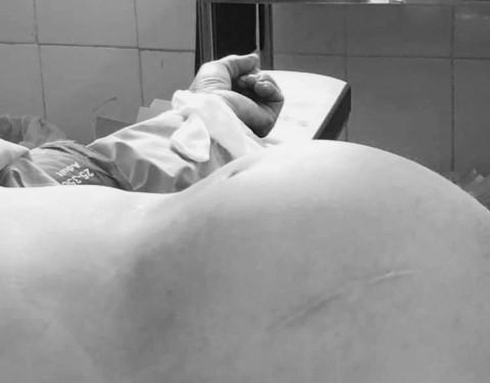 Kinh hoang cu ba U70 mang quai u gan 4kg chua ba dau, xuong va toc