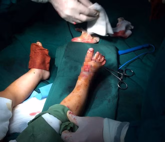 Máy cắt cỏ nhà hàng xóm cắt nát hai bàn chân bé 2 tuổi May cat co nha hang xom cat nat hai ban chan be 2 tuoi