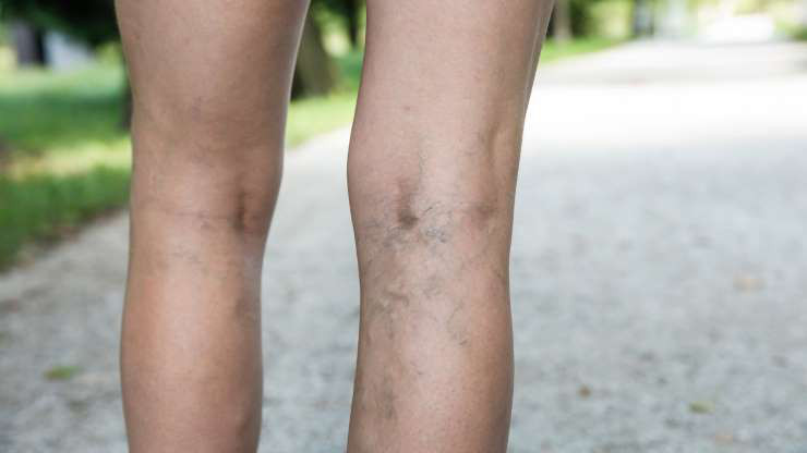 Giãn tĩnh mạch - Căn bệnh này có thể gặp ở cả những người ngôi quá nhiều hay đứng quá lâu.