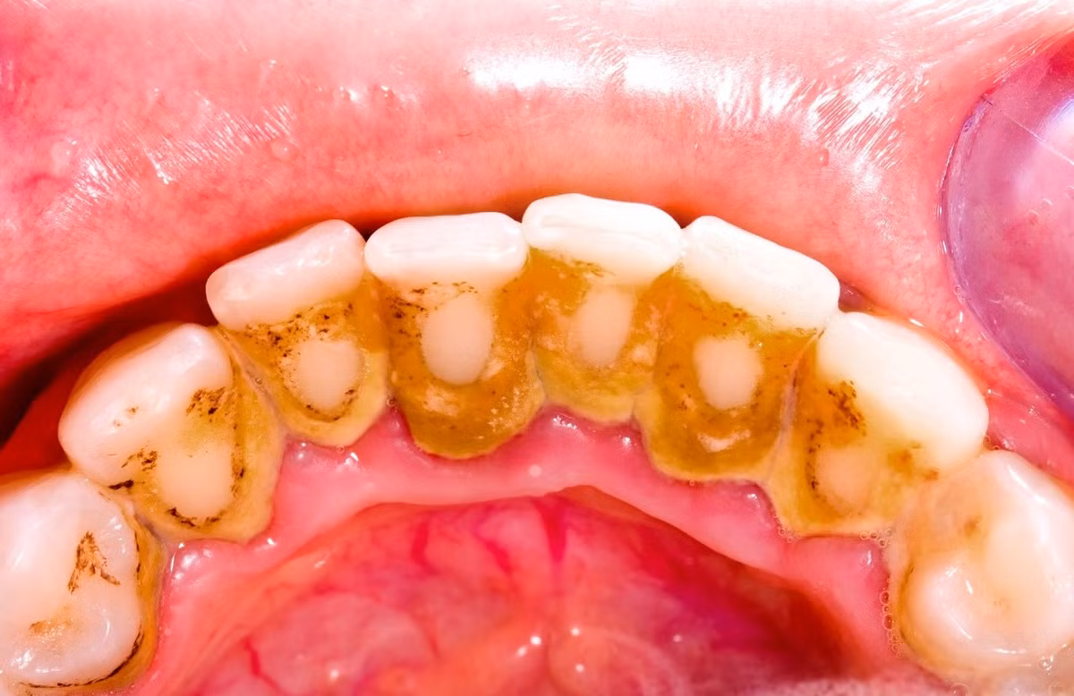 Cao rang khong ngo lai la thu pham gay nhieu benh the nay