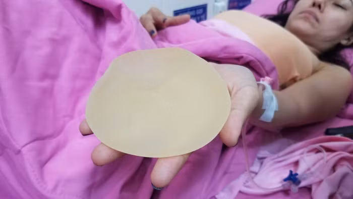 Quách Tuấn Du kể lại tình hình của Ivy Trần bị nổ túi ngực, đồng thời đưa ra cho cư dân mạng xem hình ảnhtúi ngực bị vỡ bởi chất lượng kém. Theo lời anh, nữ ca sĩ đã được các bác sĩ kịp thời xử lý bằng việc tháo bỏ túi ngực vỡ ra khỏi cơ thể, đồng thời vẫn có thể đặt túi ngực khác vào mà không bị nhiễm trùng.