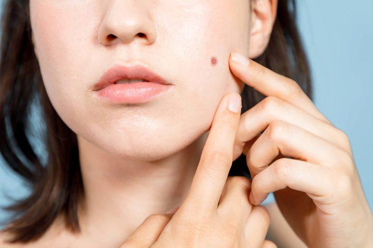 Nước gừng cũng giúp bạn giảm mụn, các nốt sưng đỏ và hạn chế tái phát mụn trong tương lai.