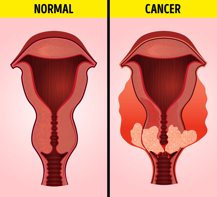 Chuong bung, day hoi canh bao 6 van de suc khoe nghiem trong sau-Hinh-5