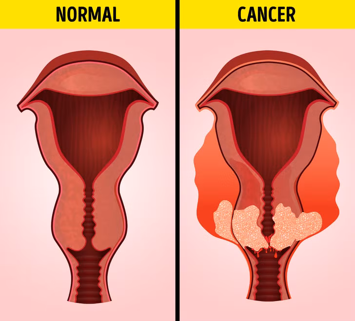 Chuong bung, day hoi canh bao 6 van de suc khoe nghiem trong sau-Hinh-5