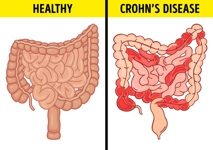 Chuong bung, day hoi canh bao 6 van de suc khoe nghiem trong sau-Hinh-3
