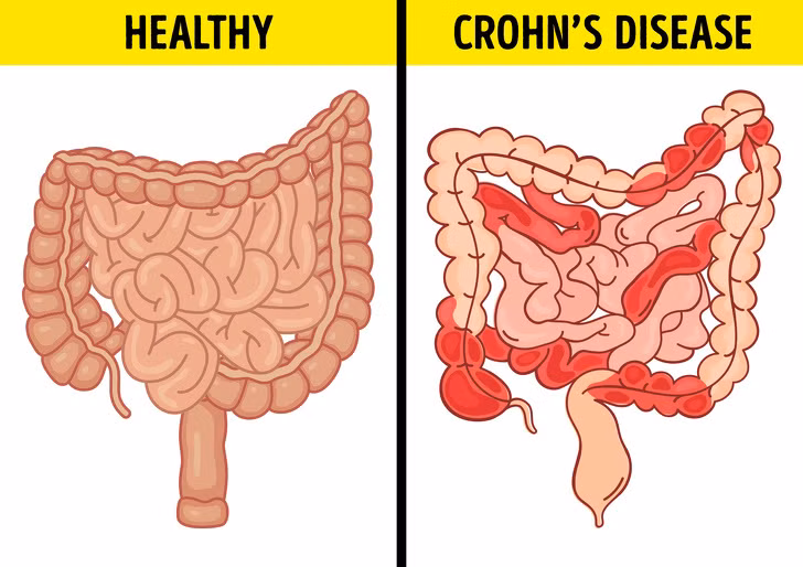 Chuong bung, day hoi canh bao 6 van de suc khoe nghiem trong sau-Hinh-3
