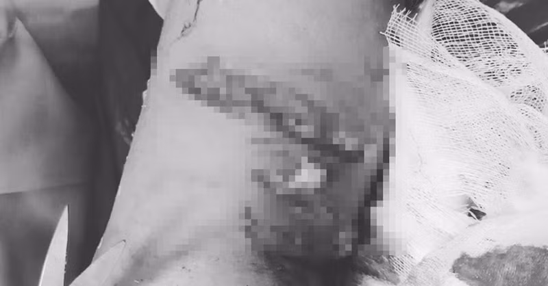 Xot xa nhung truong hop tre nho bi cho can ton thuong nghiem trong