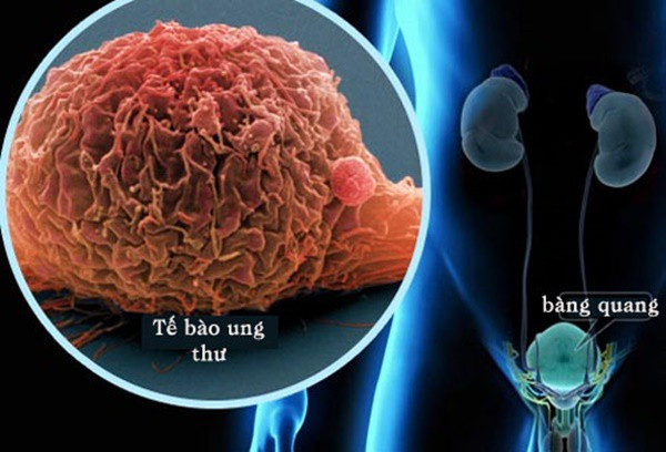 Dau hieu ung thu dang tan cong, de nham voi benh thong thuong