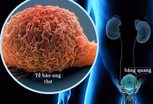 Dau hieu ung thu dang tan cong, de nham voi benh thong thuong