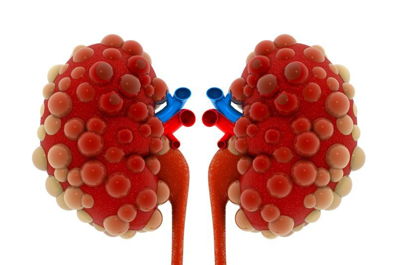 Bệnh thận mãn tính: Những người mắc bệnh thận thường bị thiếu máu do thận bị tổn thương không sản sinh đủ hormone erythropoietin. Đây là hormone thúc đẩy tủy xương sản sinh hồng cầu, do đó thiếu erythropoietin có thể gây thiếu máu. Dạng thiếu máu này thường dẫn đến các biến chứng tim và cơ bắp.