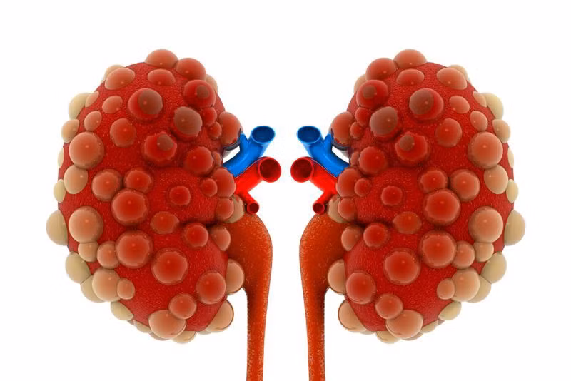 Bệnh thận mãn tính: Những người mắc bệnh thận thường bị thiếu máu do thận bị tổn thương không sản sinh đủ hormone erythropoietin. Đây là hormone thúc đẩy tủy xương sản sinh hồng cầu, do đó thiếu erythropoietin có thể gây thiếu máu. Dạng thiếu máu này thường dẫn đến các biến chứng tim và cơ bắp.