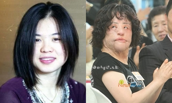 Ca sĩ Han Mi Ok cũng là một ca “dao kéo” thất bại. Khi cô trở lại truyền hình với khuôn mặt đáng sợ, dư luận kinh ngạc và gọi đây là ca phẫu thuật hỏng kinh hoàng nhất xứ Hàn, khiến khán giả choáng váng không dám nhìn.