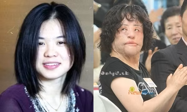 Ca sĩ Han Mi Ok cũng là một ca “dao kéo” thất bại. Khi cô trở lại truyền hình với khuôn mặt đáng sợ, dư luận kinh ngạc và gọi đây là ca phẫu thuật hỏng kinh hoàng nhất xứ Hàn, khiến khán giả choáng váng không dám nhìn.