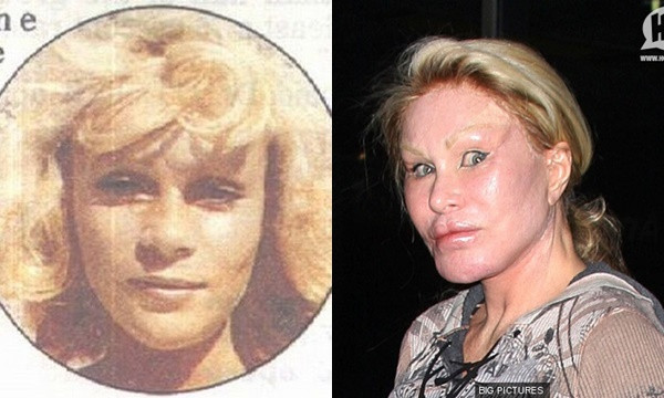 Ca sĩ Jocelyne đã trải qua rất nhiều đau đớn từ những cuộc phẫu thuật. Nữ ca sĩ đã chi hàng triệu đô la cho làm mắt, bơm môi, căng da mặt, tuy nhiên bà lại phải trả cái giá quá đắt khi lạm dụng “dao kéo”, mí mắt bị kéo căng thậm chí không thể nhắm mắt lại khi ngủ, nhìn vô cùng đáng sợ.