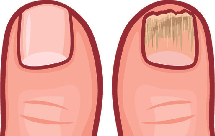 Móng chân dễ gãy và trông xấu xí: Trọng lực kéo chất độc xuống cơ thể bạn và móng chân có thể là nơi phải hứng chịu.