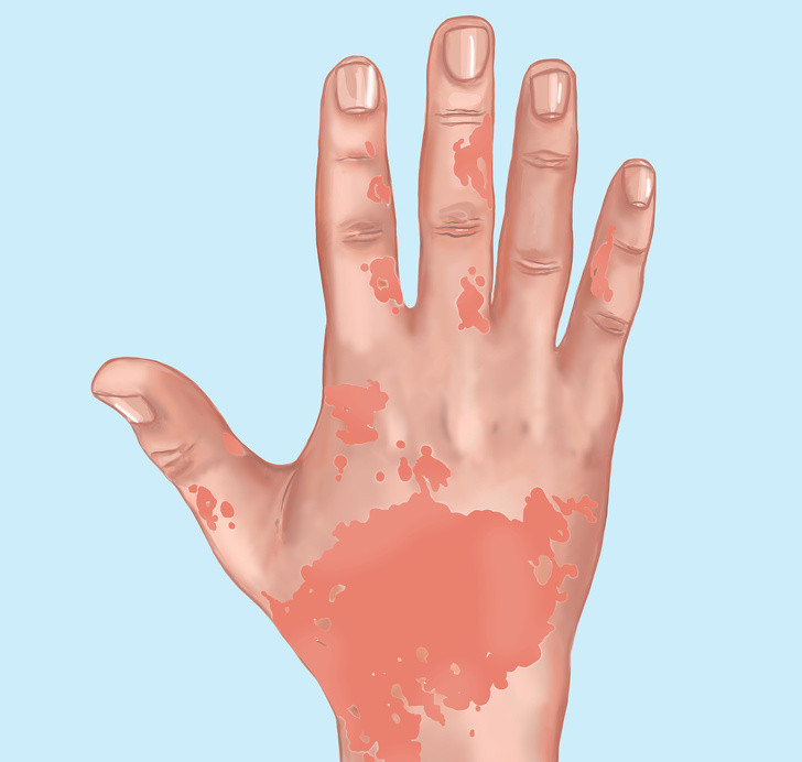 Những thay đổi lạ xuất hiện trên da: Da là cơ quan lớn nhất trong cơ thể chúng ta và thường xuyên phải tiếp xúc với môi trường ô nhiễm vì vậy nó rất dễ bị nhiễm độc. Ngoài ra, các sản phẩm như dầu gội, dầu xả, xà phòng và kem dưỡng da mà chúng ta sử dụng có thể chứa các hóa chất độc hại cũng có thể gây hại cho da. Tiếp xúc với nhiều hóa chất độc hại có thể dẫn đến các triệu chứng như mụn trứng cá, phát ban và bệnh chàm.