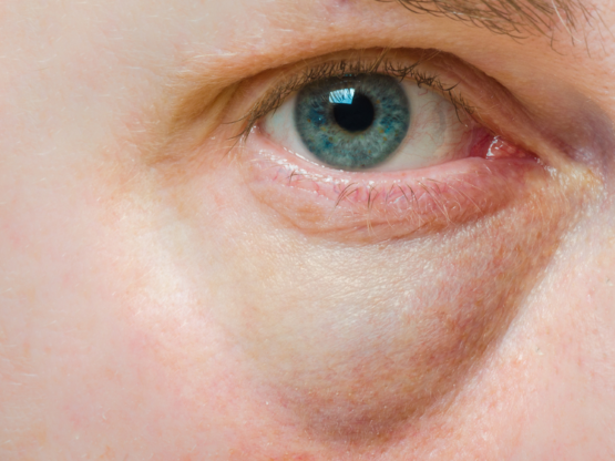 Vết cắn sưng tấy bất thường - Sưng tấy ở môi, họng hay mi mắt cũng là dấu hiệu thông thường của sốc mẫn cảm với côn trùng và bạn nên tới bệnh viện để kiểm tra và được chỉ định dùng epinephrine.