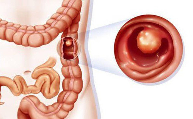 Dau hieu som canh bao ung thu dai trang “cuop mang” ca si Vuong Bao Tuan